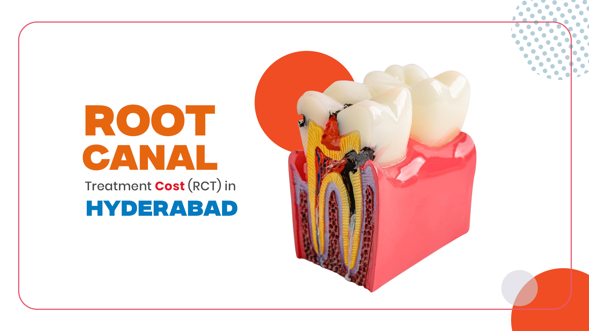 Root Canal Treatment Cost in Hyderabad